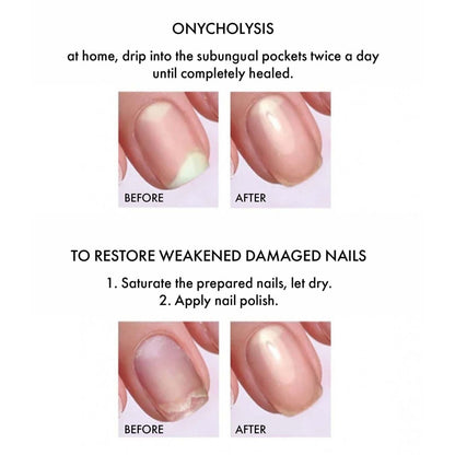 Antifungal – nail growth stimulator, 15 ml.